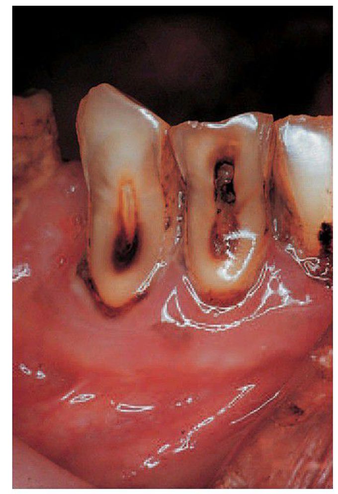 Mixed pattern tooth loss.