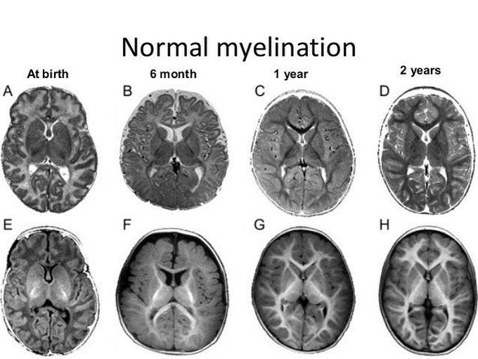Normal myelination