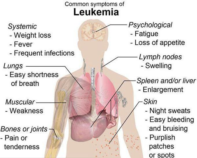 Symptoms of leukemia