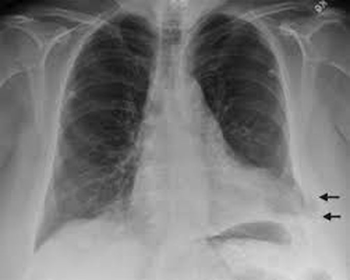 Lung hernia