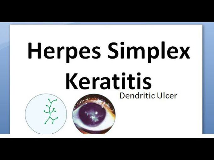 Herpes Simplex keratitis (opthalmicus)