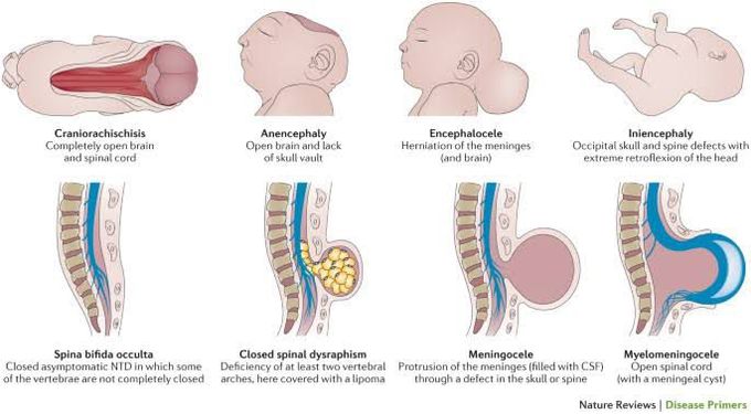 Neural Tube Defects