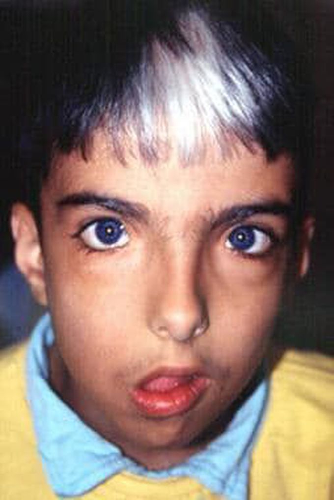 Waardenburg Syndrome