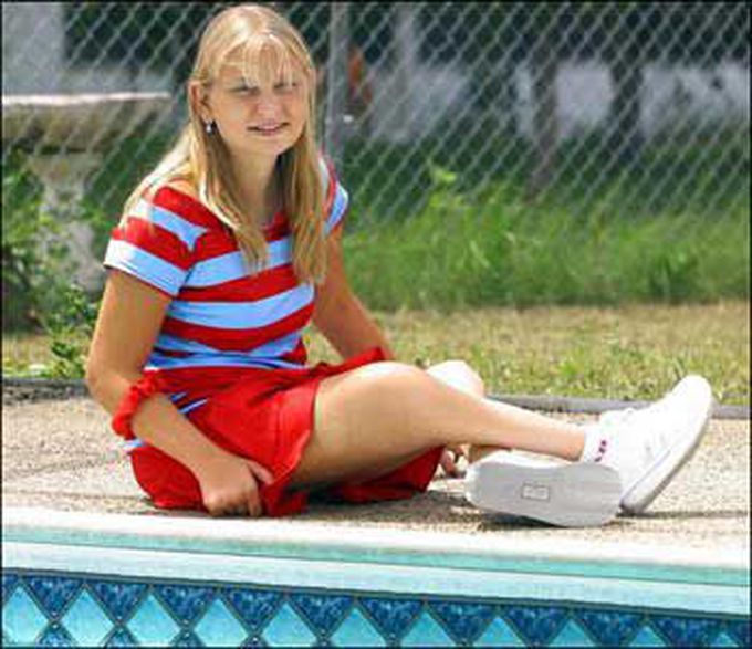 Successful operation to seperate the feet of a girl mermaid sydrome