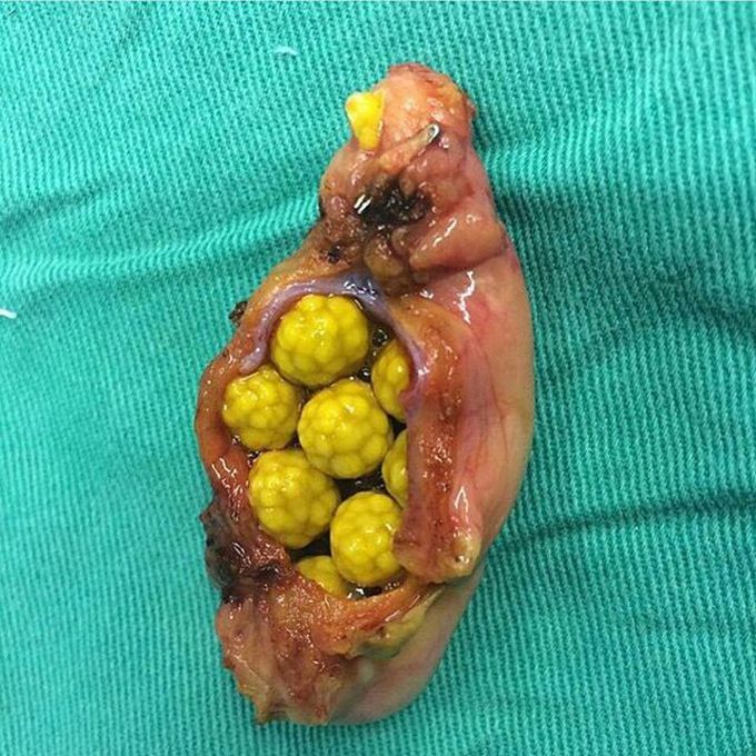 Gallstones