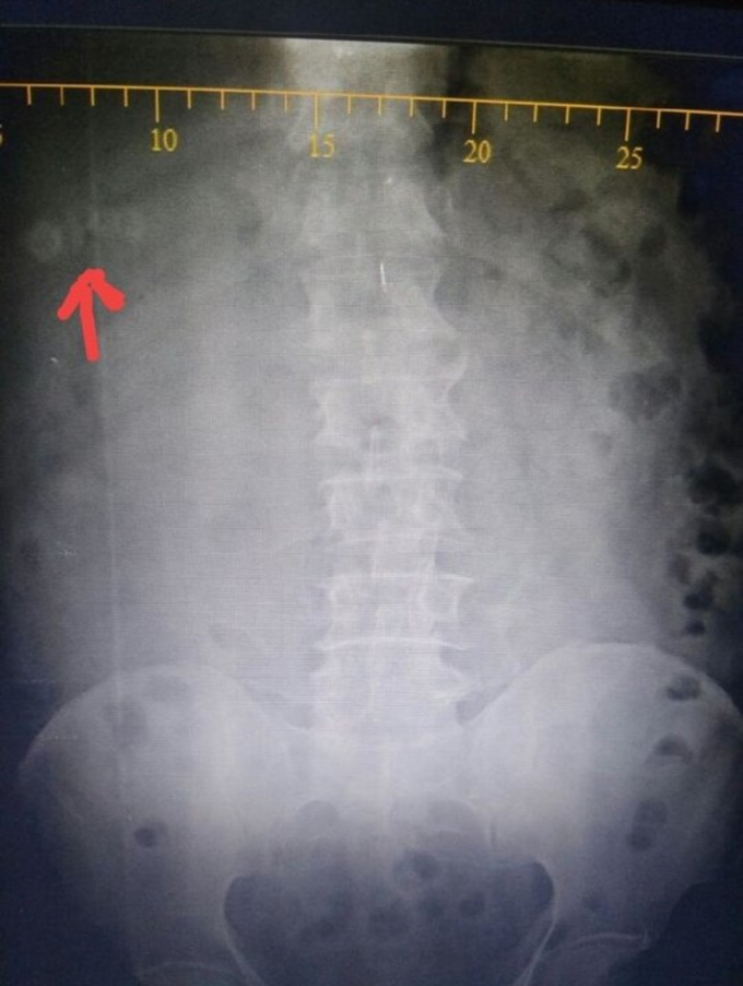 This is not a case,just a rare finding of visible gallstones on abdominal X-Ray.