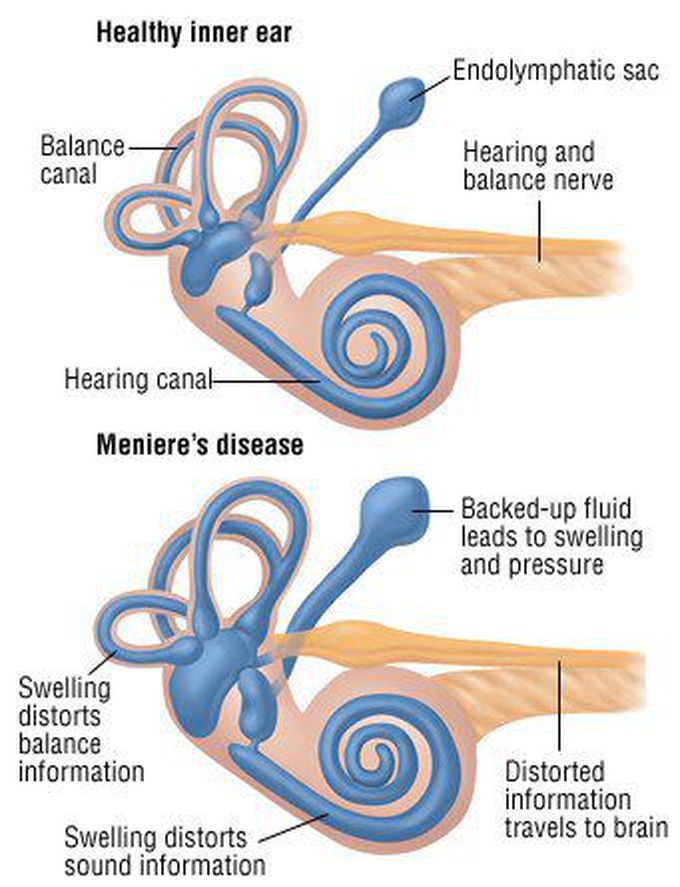 Meniere's disease. MEDizzy
