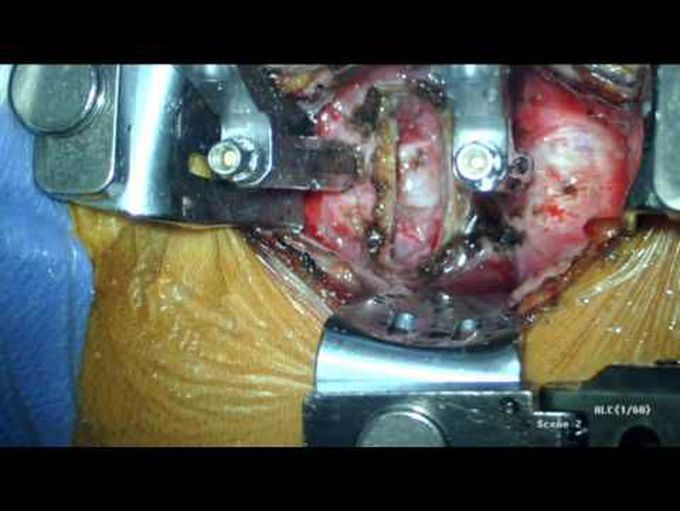 Stepwise illustration of teeth-fixation semi-constrained cervical disc arthroplasty