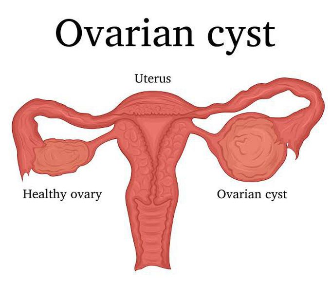 How diagnosis of ovarian cyst is made?
