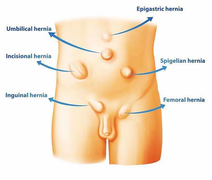 Types of hernia