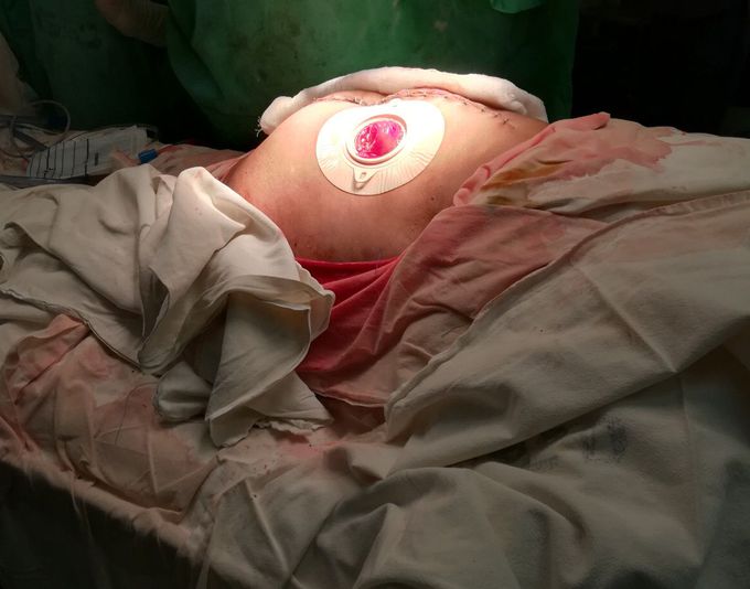 Colostomy creation