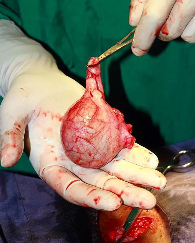 A cutaneous cyst (epidermal inclusion cyst) perfectly resected!