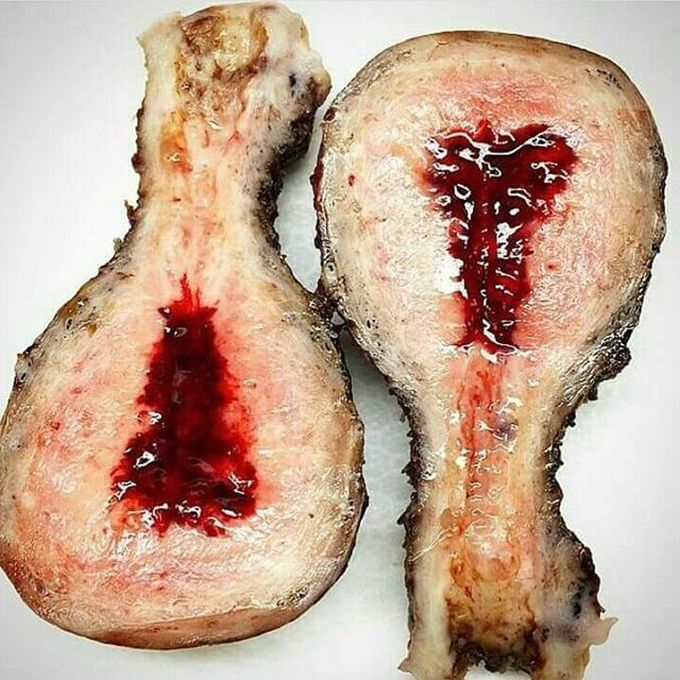 Uterus dissection