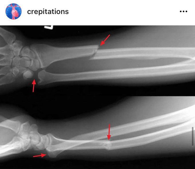 Galeazzi Fracture (xRay)