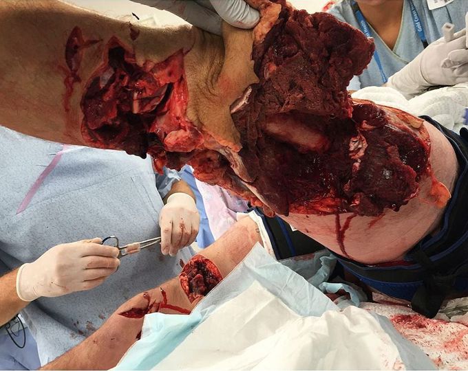 Shark attack extensively injuring both legs!!⚠️⁣🦈⁣ 