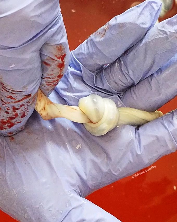 The umbilical cord have tied a knot in utero!  