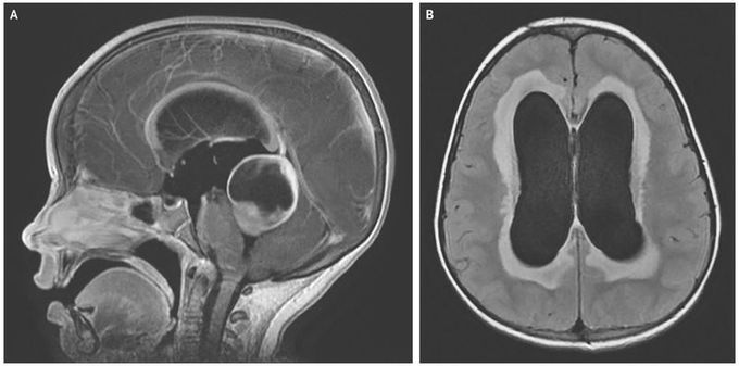 Obstructive Hydrocephalus