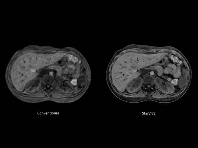 Abdominal imaging contains many breath-hold (BH) acquisitions