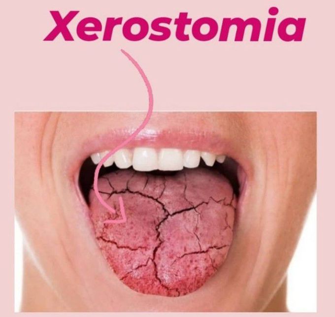 Xerostomia