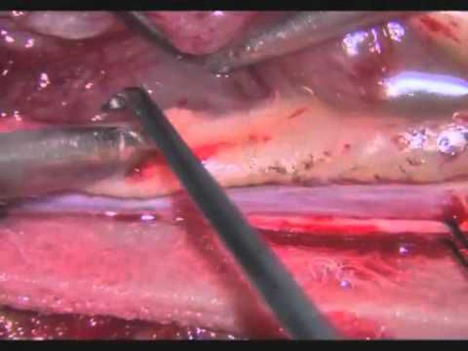 Laser-assisted microsurgical resection of thoracic intramedullary spinal cord ependymoma