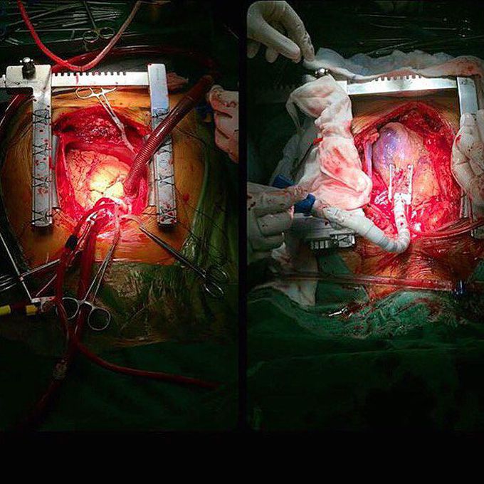 On-pump (left) vs. off-pump (right) coronary artery bypass grafting (CABG) surgery