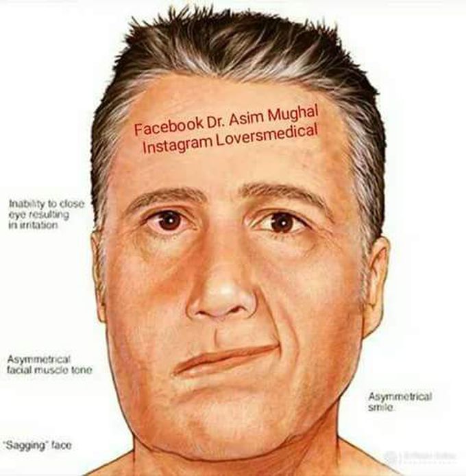 Bell's Palsy