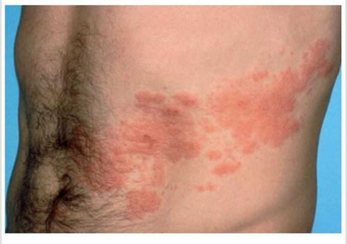 Case  of skin