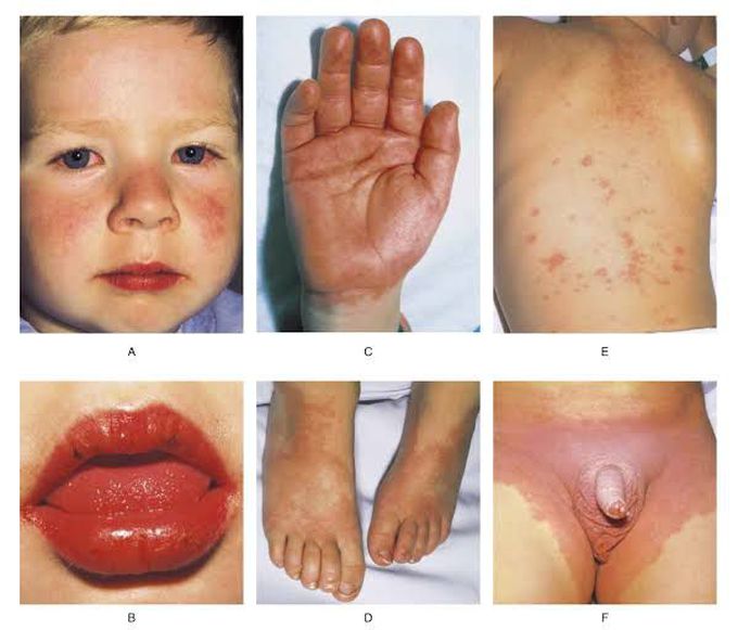 Treatment of kawasaki disease