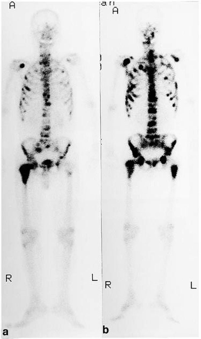 Bone Metastases from Prostate Cancer