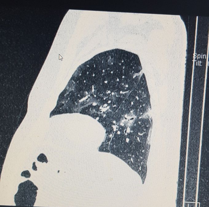 Lateral torax CT. COVID-19