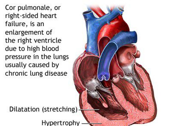 Cor pulmonale