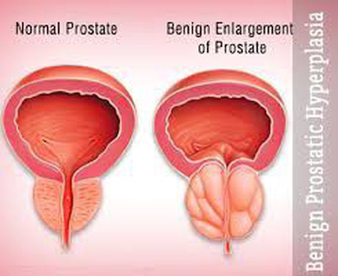 Causes of benign prostatic hyperplasia