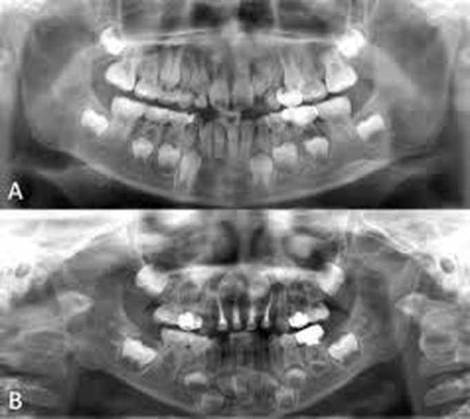 Hyperhypodontia