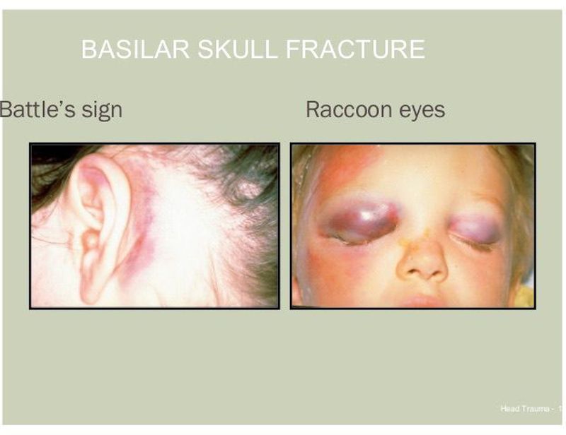 Basal skull fracture - MEDizzy