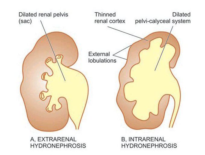 Hydronephrosis