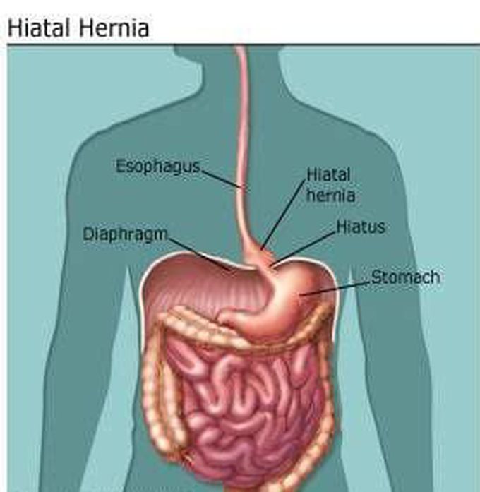 Hiatal hernia