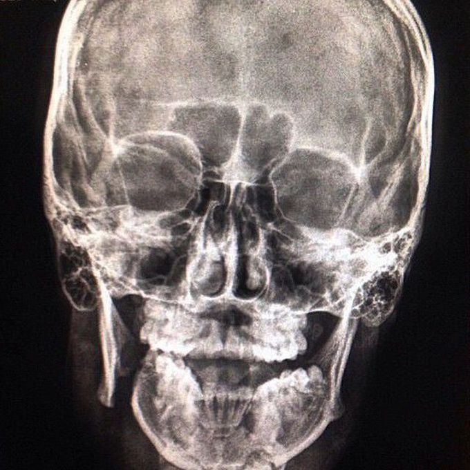 Radiograph of a mandibular fracture