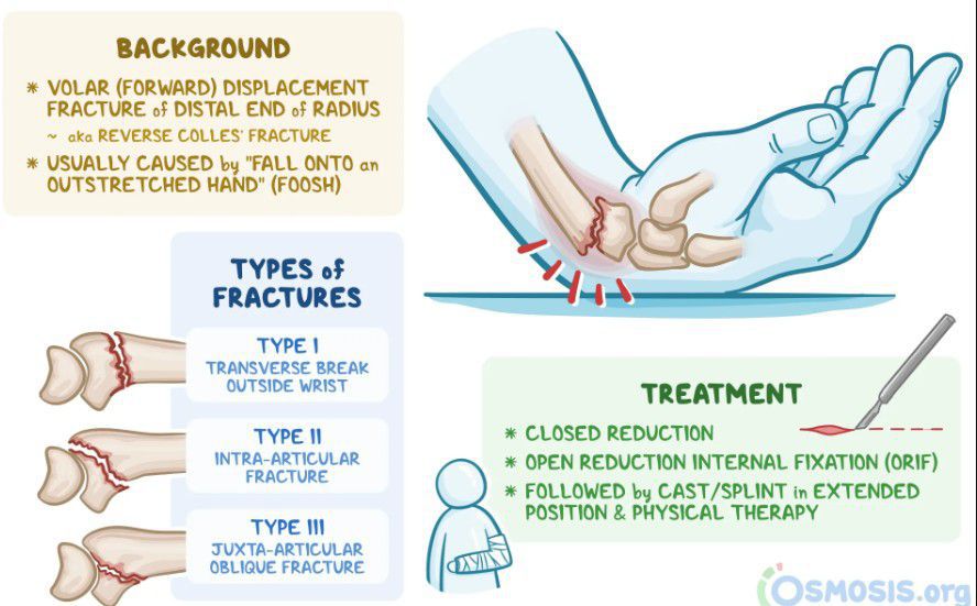 Types of fracture - MEDizzy