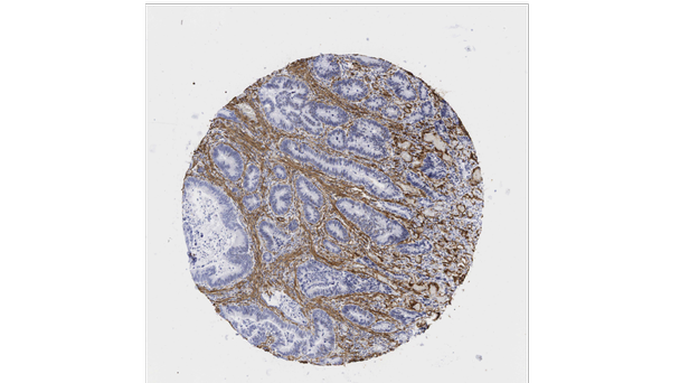 Dual-action cancer-killing virus developed by Oxford scientists 