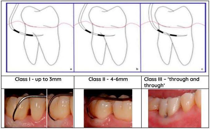 Furcation Types