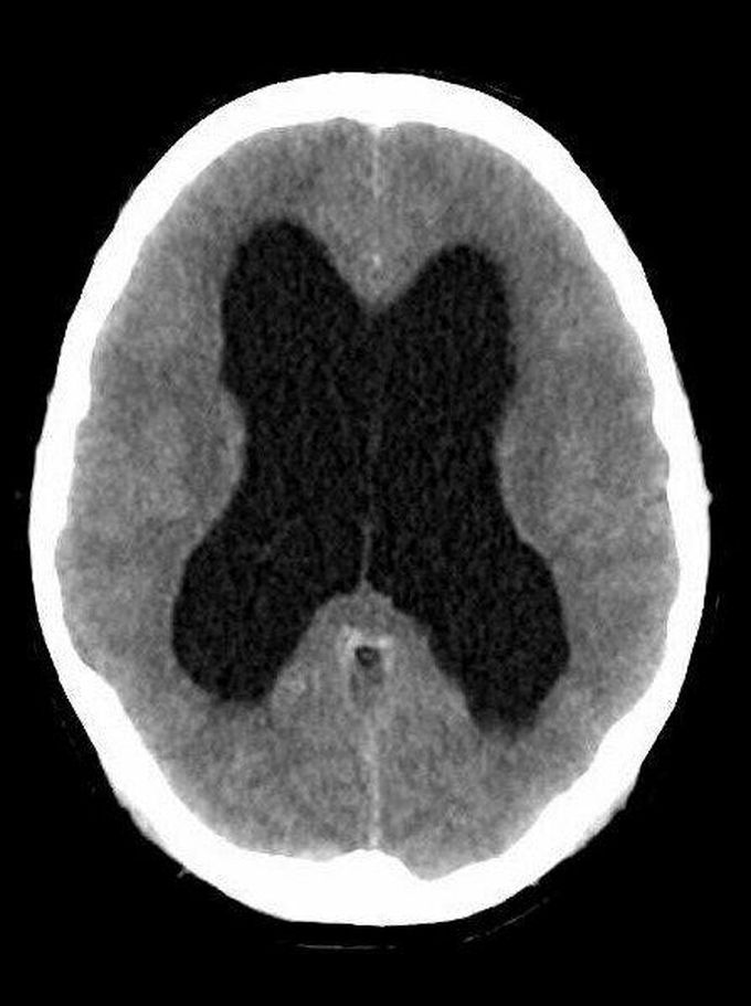 Non-communicating hydrocephalus, with dilated lateral and third ventricle, but normal fourth ventricle.