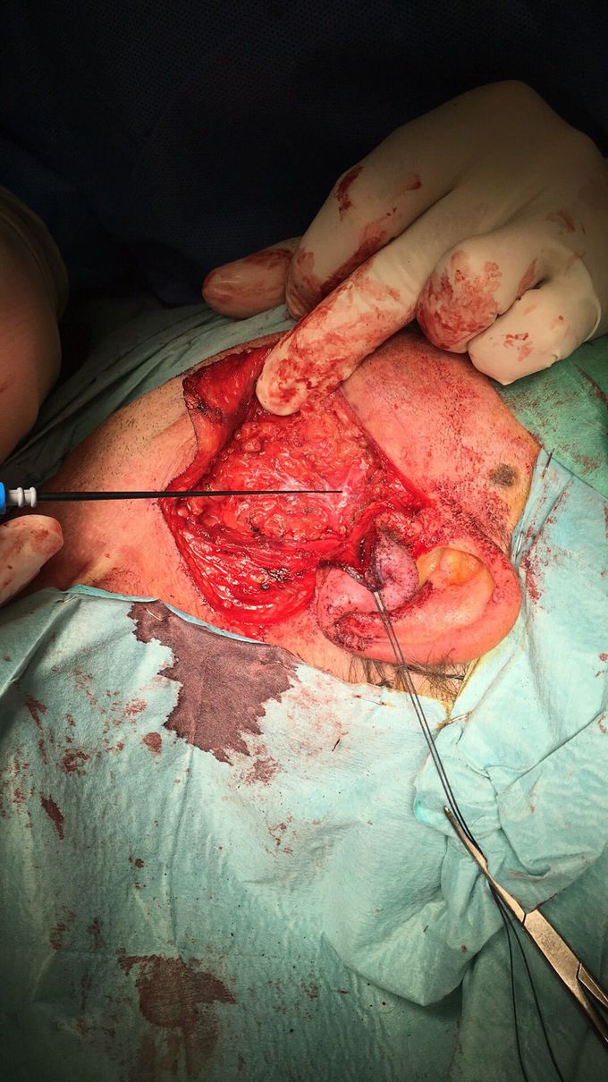 Facial nerve