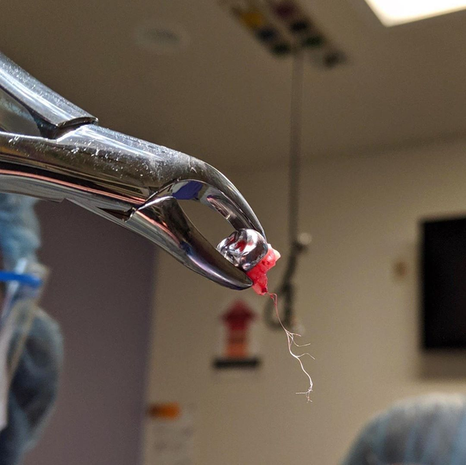 Tooth nerve