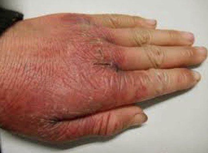 Deficiency of what vitamin ....?