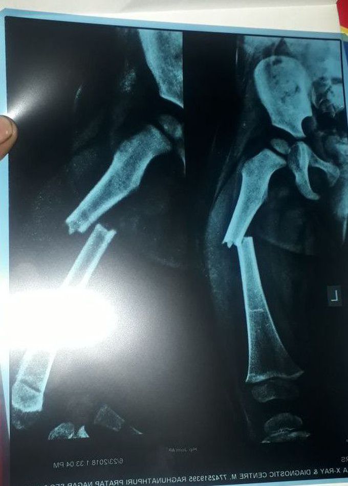Diagnosis this fracture?