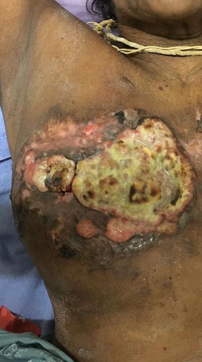 Localy advanced breast cancer. Labc.