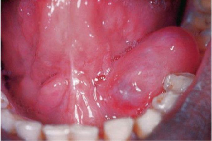 Mucus retention cyst (Ranula)