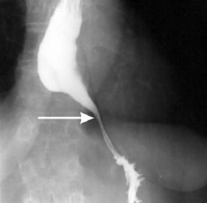 Эндоскопические признаки кардии. Ахалазия кардии пищевода. Ахалазия кардии рентген. Ахалазия кардии пищевода рентген. Кардиоспазм и ахалазия пищевода рентген.