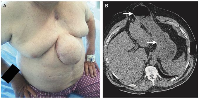 Transsternal Gastric Hernia