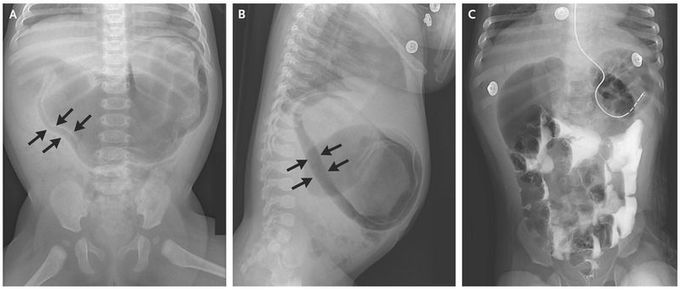 Gastric Pneumatosis